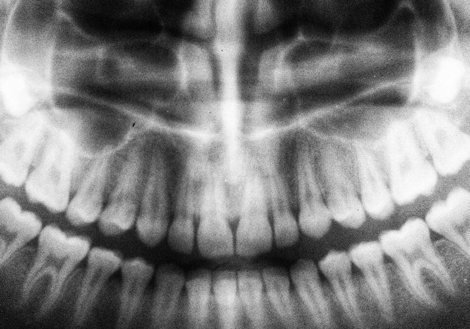 Everything you need to know about dental implants